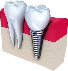 dentures in alabama